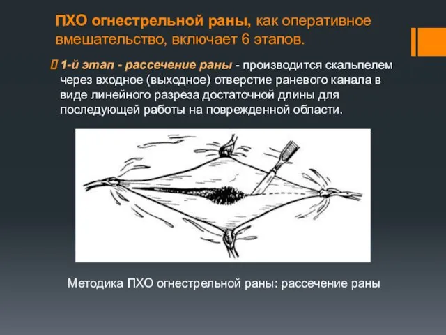 ПХО огнестрельной раны, как оперативное вмешательство, включает 6 этапов. 1-й этап