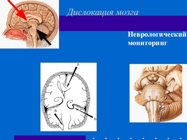 Дислокация мозга Неврологический мониторинг