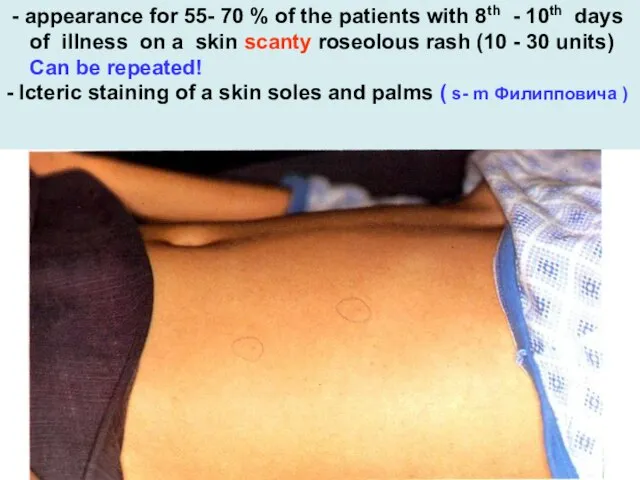 - appearance for 55- 70 % of the patients with 8th