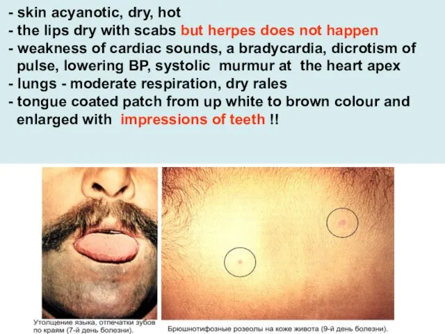 - skin acyanotic, dry, hot - the lips dry with scabs