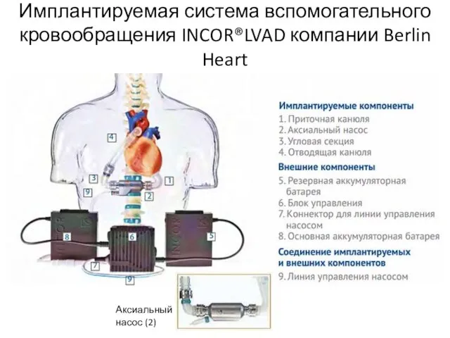 Имплантируемая система вспомогательного кровообращения INCOR®LVAD компании Berlin Heart Аксиальный насос (2)