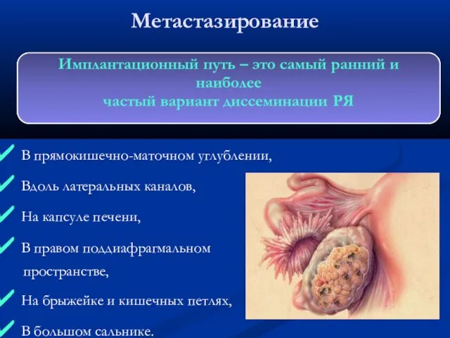 Метастазирование В прямокишечно-маточном углублении, Вдоль латеральных каналов, На капсуле печени, В