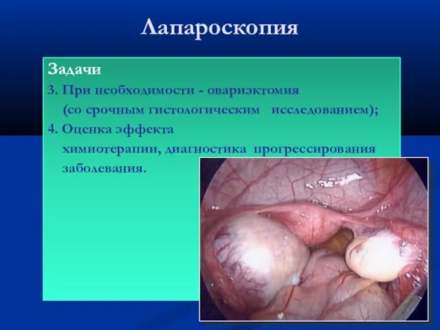 Лапароскопия Задачи 3. При необходимости - овариэктомия (со срочным гистологическим исследованием);