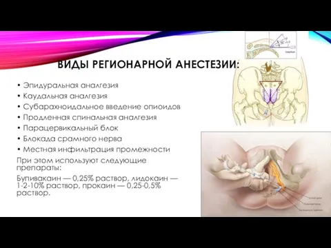 • Эпидуральная аналгезия • Каудальная аналгезия • Субарахноидальное введение опиоидов •