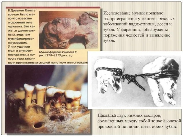 Исследование мумий показало распространение у египтян тяжелых заболеваний надкостницы, десен и