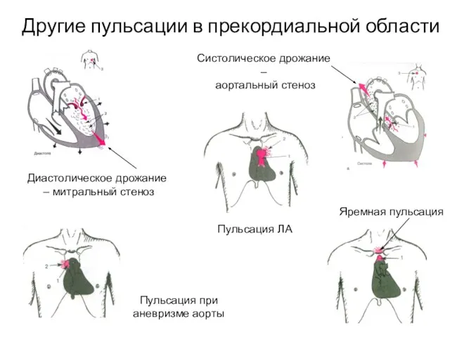 Другие пульсации в прекордиальной области Пульсация ЛА Яремная пульсация Диастолическое дрожание