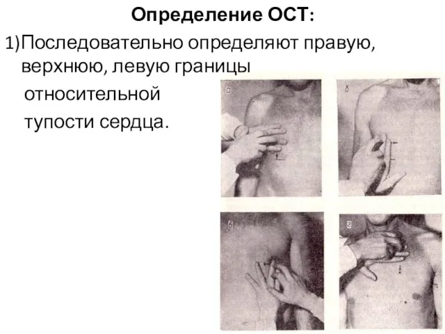 Определение ОСТ: 1)Последовательно определяют правую, верхнюю, левую границы относительной тупости сердца.