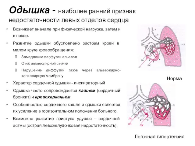 Одышка - наиболее ранний признак недостаточности левых отделов сердца Возникает вначале