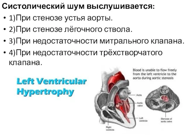 Систолический шум выслушивается: 1)При стенозе устья аорты. 2)При стенозе лёгочного ствола.