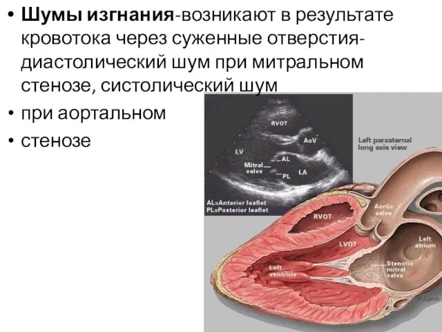 Шумы изгнания-возникают в результате кровотока через суженные отверстия- диастолический шум при