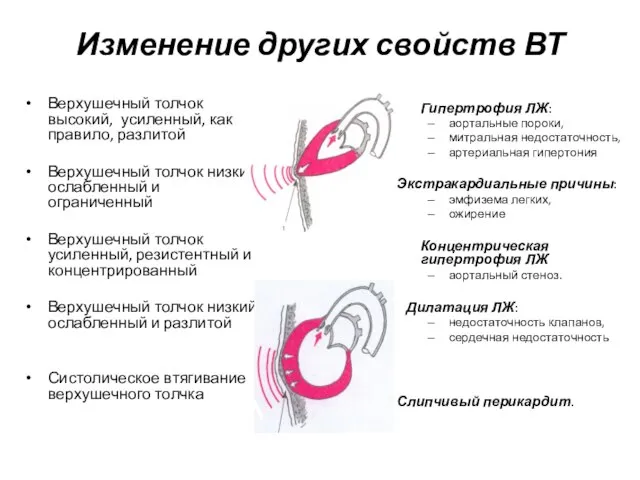 Изменение других свойств ВТ Верхушечный толчок высокий, усиленный, как правило, разлитой