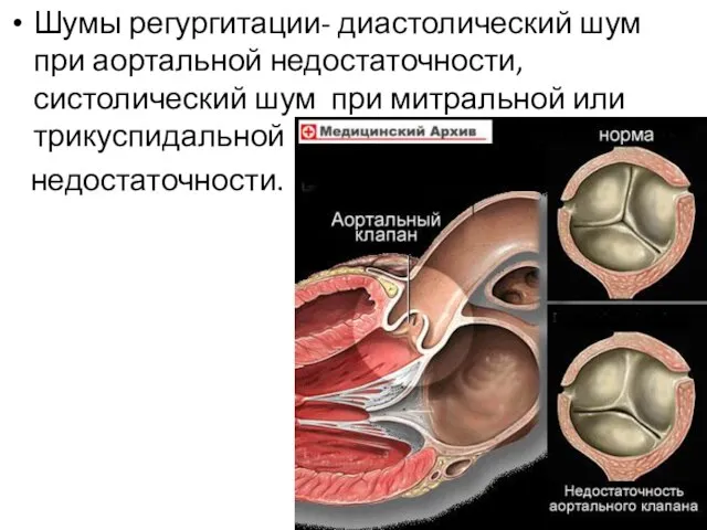 Шумы регургитации- диастолический шум при аортальной недостаточности, систолический шум при митральной или трикуспидальной недостаточности.