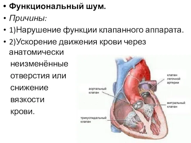 Функциональный шум. Причины: 1)Нарушение функции клапанного аппарата. 2)Ускорение движения крови через