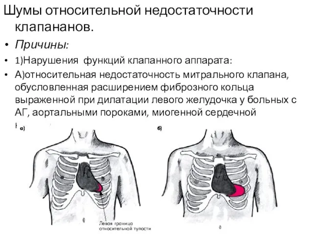 Шумы относительной недостаточности клапананов. Причины: 1)Нарушения функций клапанного аппарата: А)относительная недостаточность