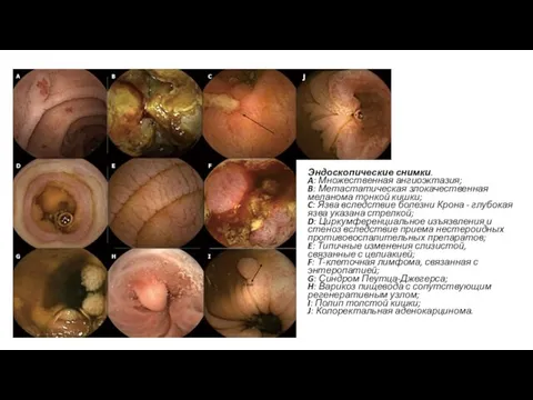 Эндоскопические снимки. A: Множественная ангиоэктазия; B: Метастатическая злокачественная меланома тонкой кишки;