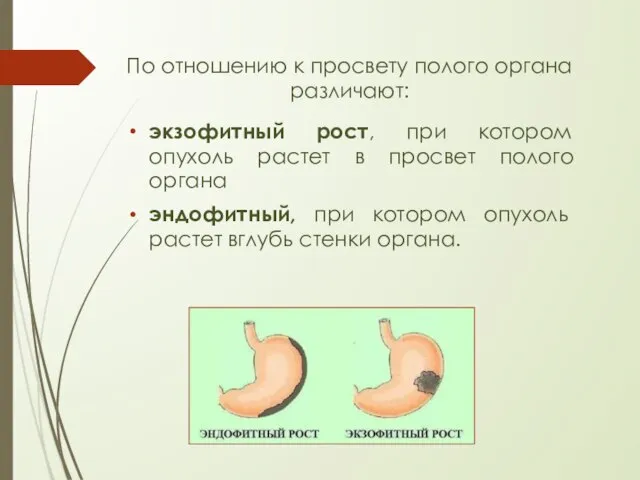 По отношению к просвету полого органа различают: экзофитный рост, при котором