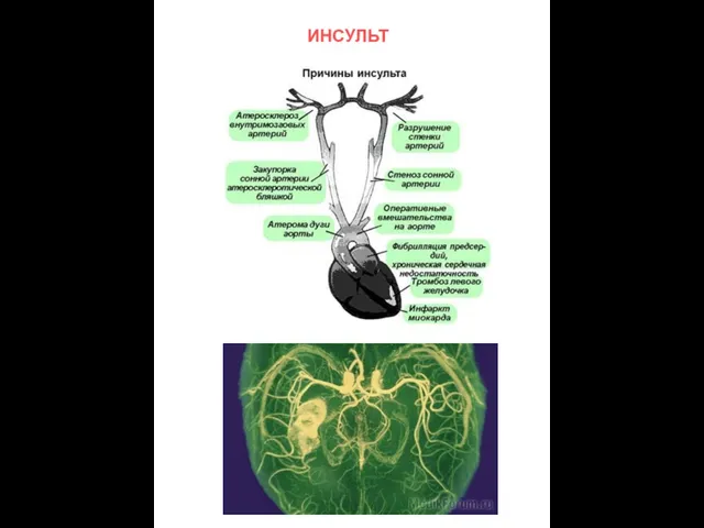 ИНСУЛЬТ