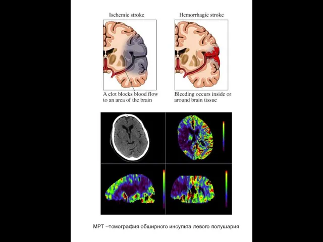 МРТ –томография обширного инсульта левого полушария