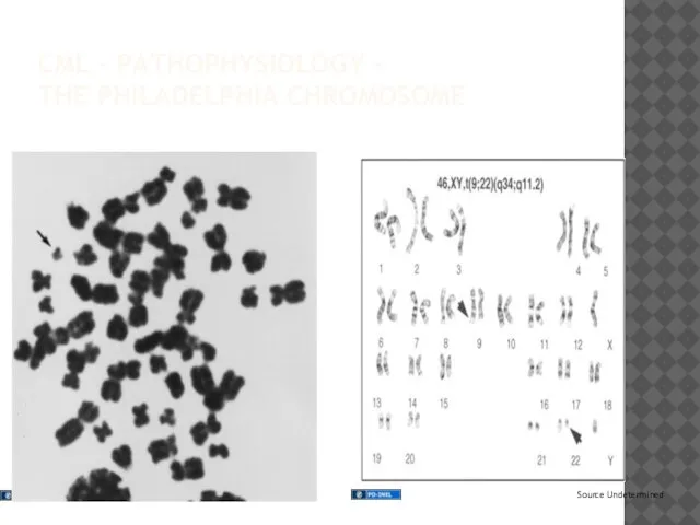 CML – PATHOPHYSIOLOGY – THE PHILADELPHIA CHROMOSOME