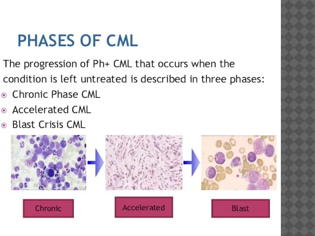 PHASES OF CML The progression of Ph+ CML that occurs when