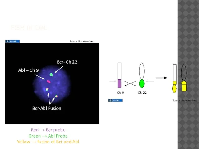 FISH IN CML Red → Bcr probe Green → Abl Probe