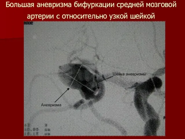 Большая аневризма бифуркации средней мозговой артерии с относительно узкой шейкой