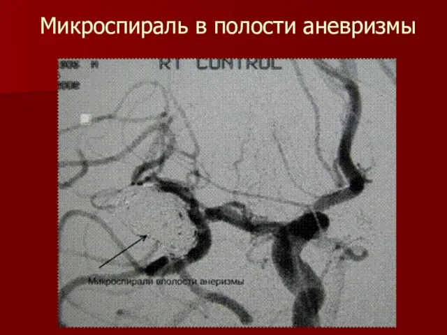 Микроспираль в полости аневризмы