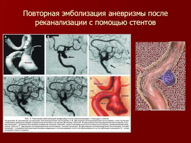 Повторная эмболизация аневризмы после реканализации с помощью стентов