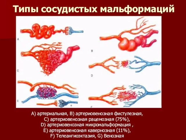 Типы сосудистых мальформаций А) артериальная, В) артериовенозная фистулезная, С) артериовенозная рацемозная