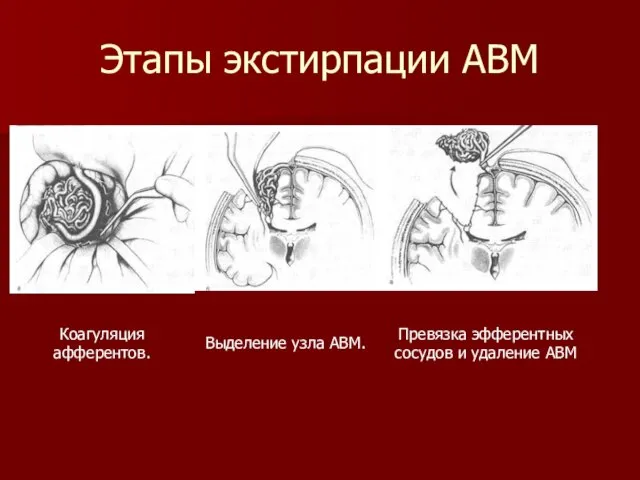 Этапы экстирпации АВМ