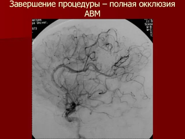 Завершение процедуры – полная окклюзия АВМ