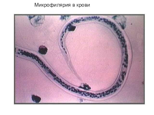 Микрофилярия в крови