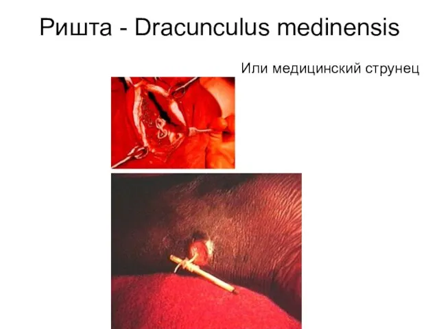 Ришта - Dracunculus medinensis Или медицинский струнец