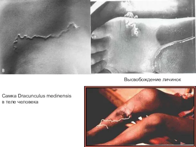Самка Dracunculus medinensis в теле человека Высвобождение личинок