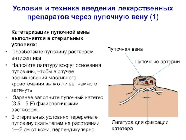 Условия и техника введения лекарственных препаратов через пупочную вену (1) Катетеризация