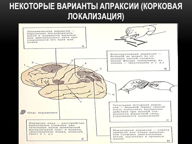 НЕКОТОРЫЕ ВАРИАНТЫ АПРАКСИИ (КОРКОВАЯ ЛОКАЛИЗАЦИЯ)