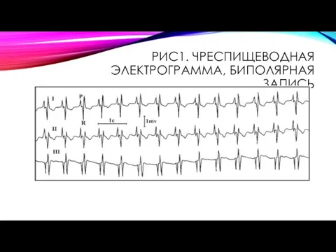 РИС1. ЧРЕСПИЩЕВОДНАЯ ЭЛЕКТРОГРАММА, БИПОЛЯРНАЯ ЗАПИСЬ