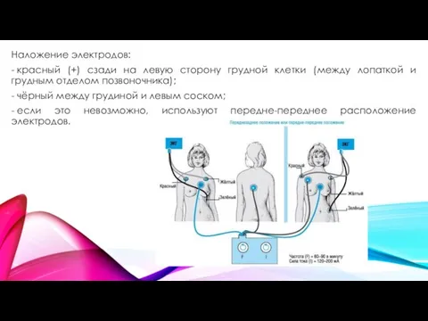 Наложение электродов: - красный (+) сзади на левую сторону грудной клетки