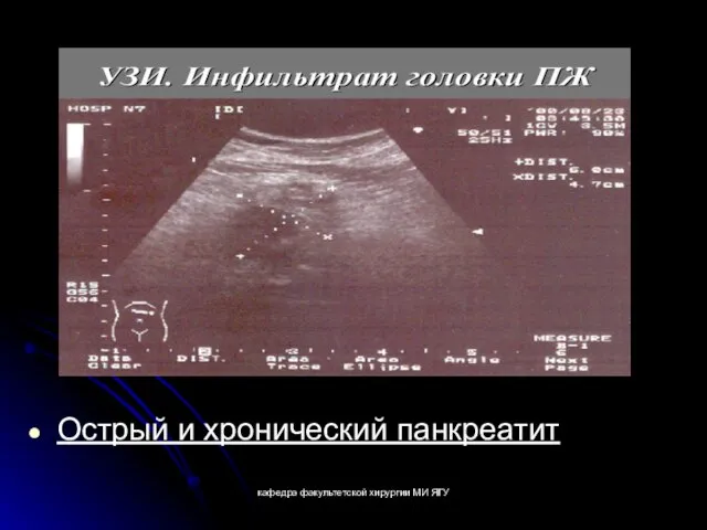 кафедра факультетской хирургии МИ ЯГУ Острый и хронический панкреатит