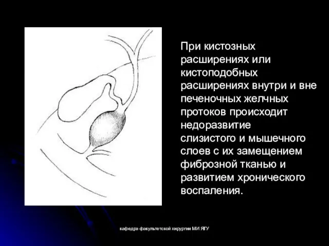 кафедра факультетской хирургии МИ ЯГУ При кистозных расширениях или кистоподобных расширениях