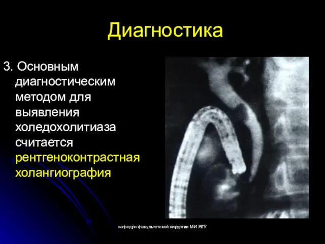 кафедра факультетской хирургии МИ ЯГУ Диагностика 3. Основным диагностическим методом для выявления холедохолитиаза считается рентгеноконтрастная холангиография