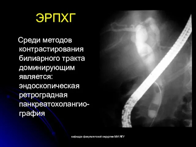 кафедра факультетской хирургии МИ ЯГУ ЭРПХГ Среди методов контрастирования билиарного тракта доминирующим является: эндоскопическая ретроградная панкреатохолангио-графия