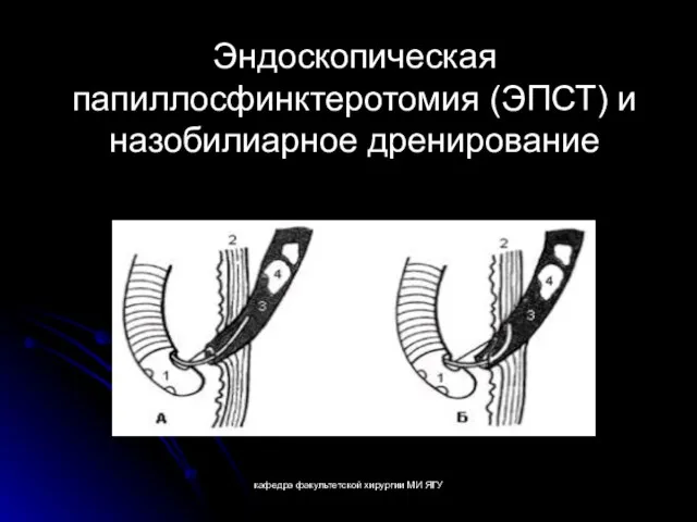 кафедра факультетской хирургии МИ ЯГУ Эндоскопическая папиллосфинктеротомия (ЭПСТ) и назобилиарное дренирование