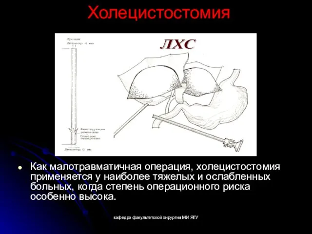 кафедра факультетской хирургии МИ ЯГУ Холецистостомия Как малотравматичная операция, холецистостомия применяется