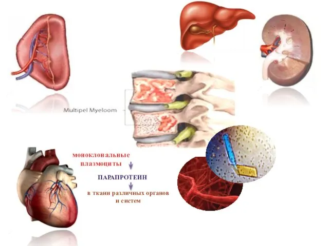 моноклональные плазмоциты ПАРАПРОТЕИН в ткани различных органов и систем