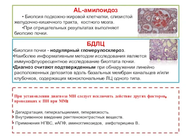 БДЛЦ Биопсия почки - нодулярный гломерулосклероз. Наиболее информативным методом исследования является