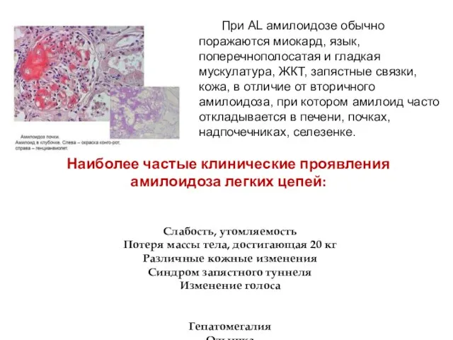 При AL амилоидозе обычно поражаются миокард, язык, поперечнополосатая и гладкая мускулатура,