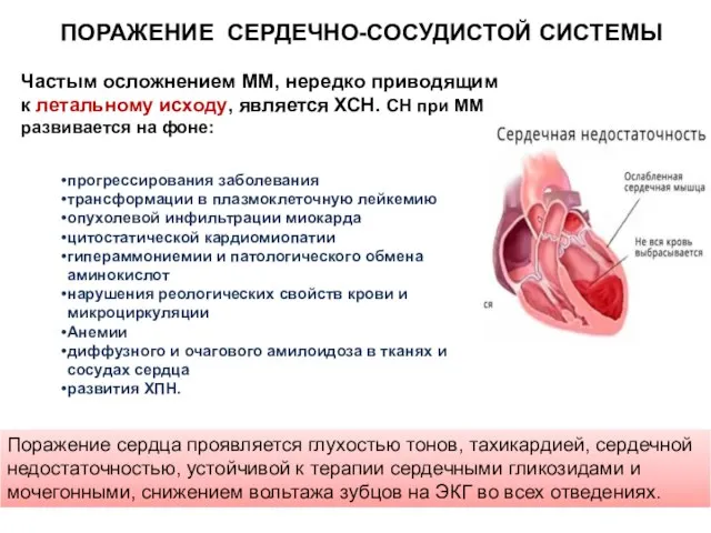 Частым осложнением ММ, нередко приводящим к летальному исходу, является ХСН. СН