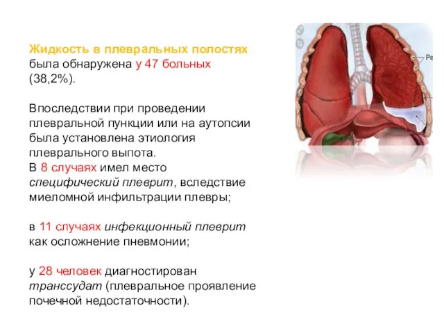 Жидкость в плевральных полостях была обнаружена у 47 больных (38,2%). Впоследствии