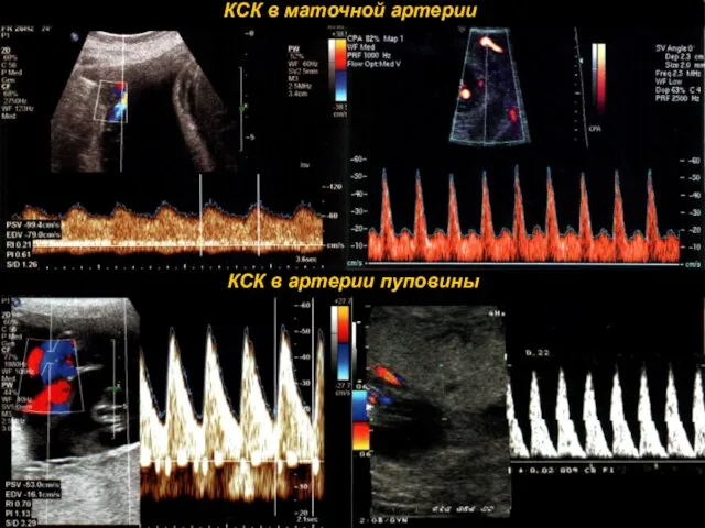 КСК в артерии пуповины